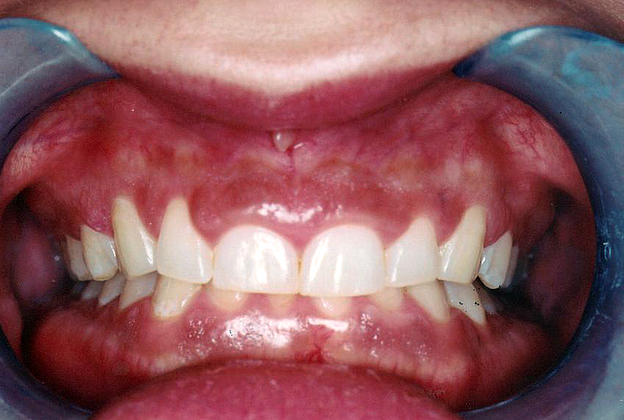 Gum Lift Case 1 - Before