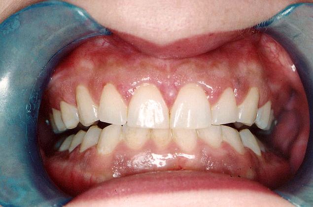 Gum Lift Case 1 - After