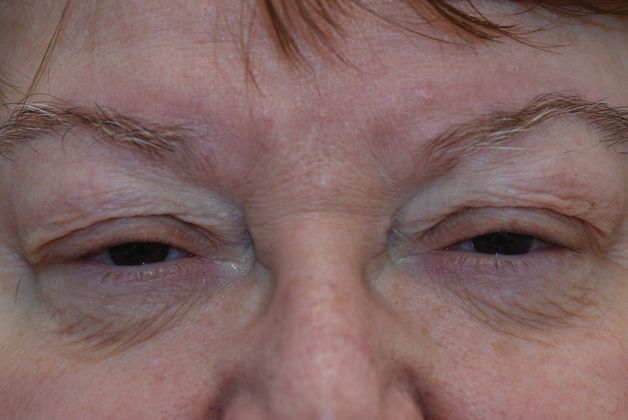 Ptosis Repair Case 10 - Before