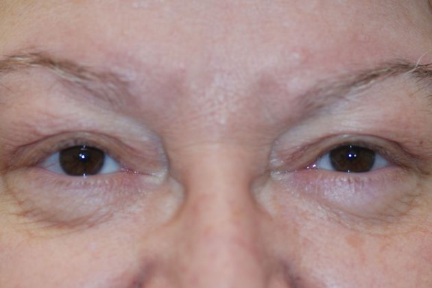 Ptosis Repair Case 10 - After