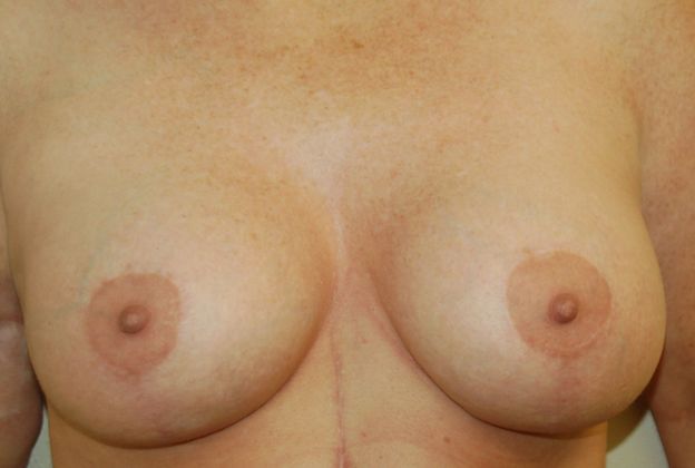 Breast Augmentation w/ Lift: Case 56 - After