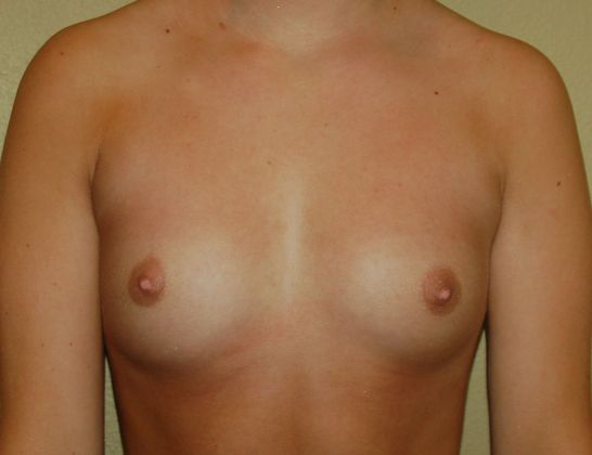 Breast Augmentation Case 151 - Before