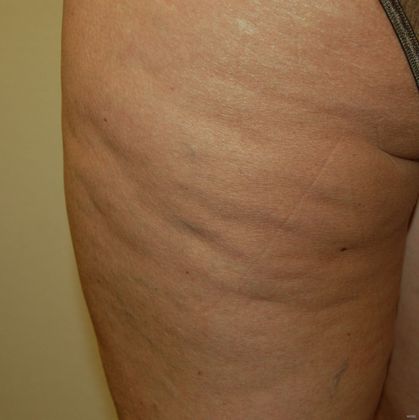 Cellulaze Cases