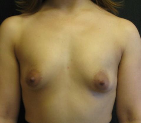 Breast Augmentation Case 13 - Before