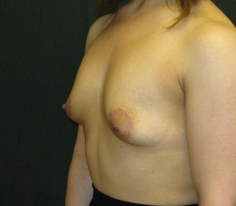 Breast Augmentation: Case 13 - before