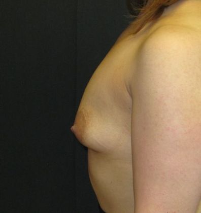 Breast Augmentation: Case 13 - before