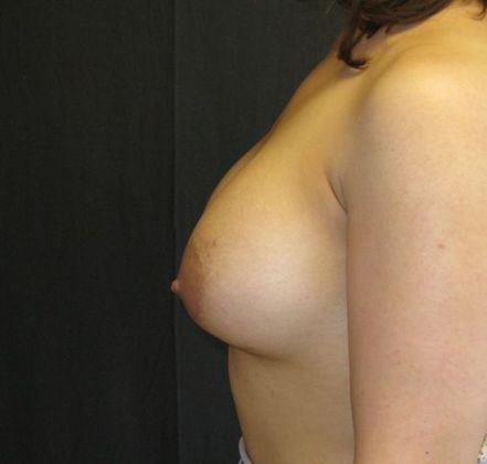 Breast Augmentation: Case 13 - after 3 months