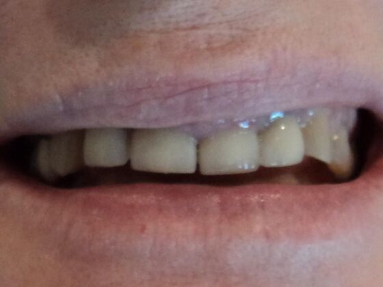 Smile Makeovers, actual cases of our dentists, no special lighting or editing: Case 3 - Before (existing unsatisfactory crowns) 