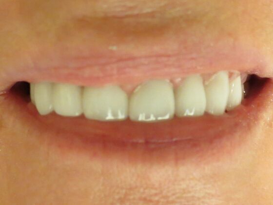 Smile Makeovers, actual cases of our dentists, no special lighting or editing: Case 3 - After All Porcelain Crowns
