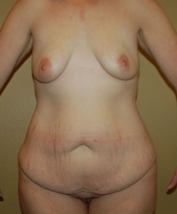 Massive Weight Loss : Case 14 - Before