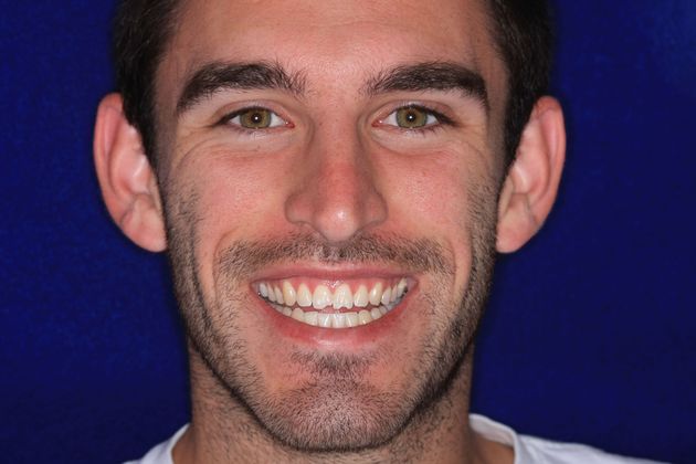 Composite Bonding: Case 1 - Before