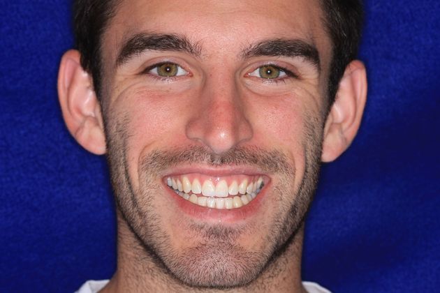 Composite Bonding: Case 1 - After