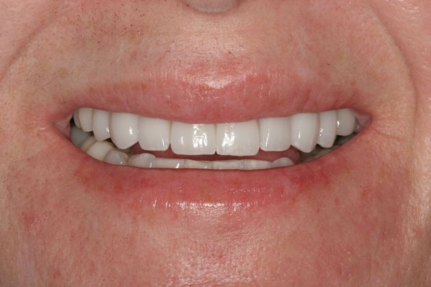 Crowns Case 2 - After