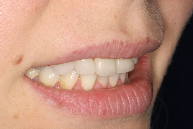 Crowns: Case 3 - Before