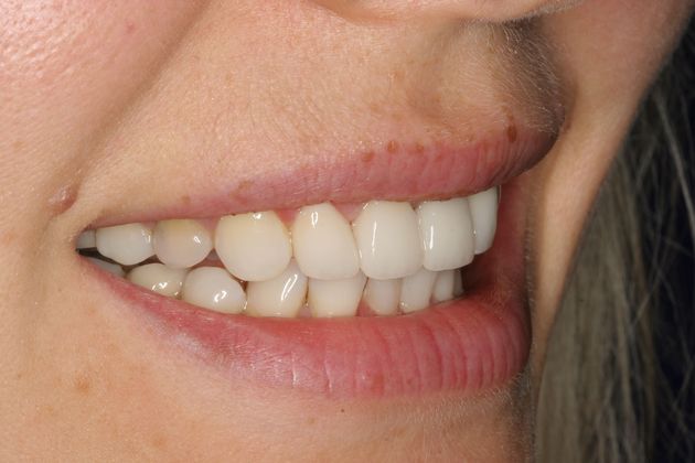 Crowns: Case 3 - After