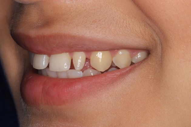 Porcelain Veneers: Case 4 - Before