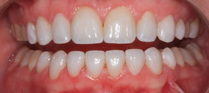 Porcelain Veneers: Case 1 - After