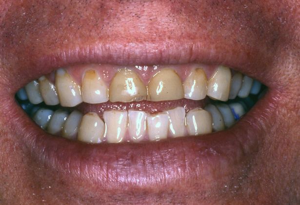 Full Mouth Rehabilitation Case 3 - Before