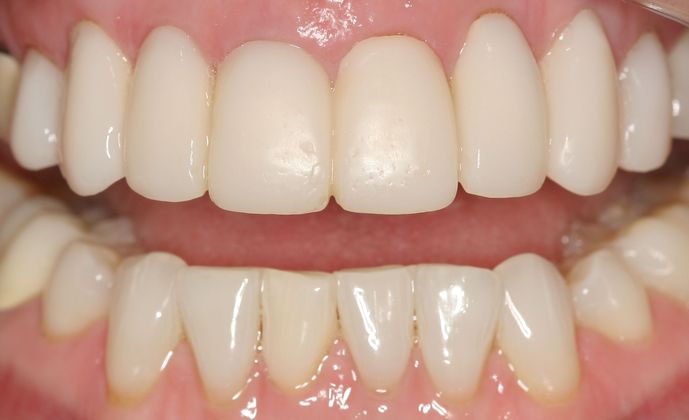 Crowns: Case 2 - Before