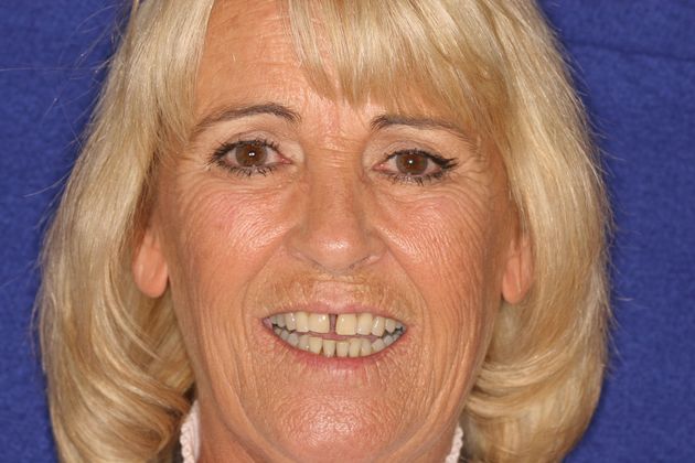 Full Mouth Rehabilitation: Case 1 - Before