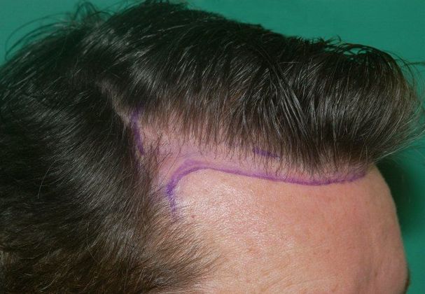 Hair Loss Surgery: 1827 Graft Frontal Hairline 