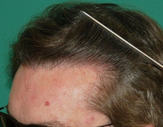 Hair Loss Surgery: 1827 Graft Frontal Hairline 