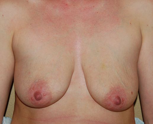 Breast Augmentation w/ Lift: Case 71 - Before