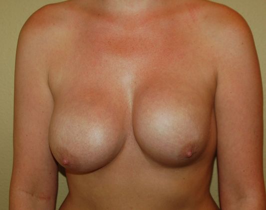 Breast Revision: Case 11 - Before