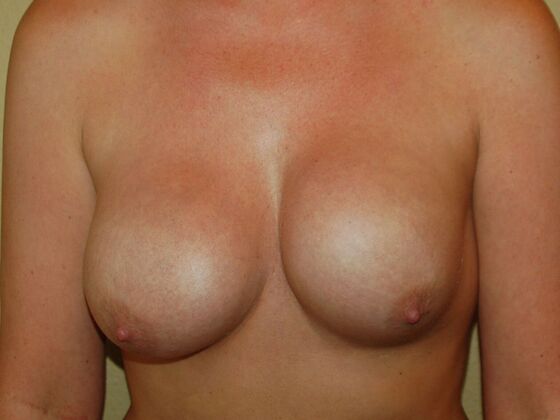 Breast Revision Case 11 - Before