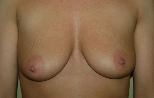 Breast Augmentation w/ Lift Case 74 - Before