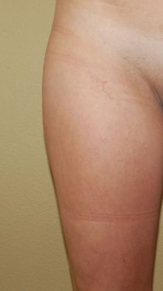 Liposuction Case 4 - After