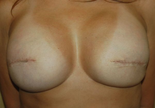 Breast Reconstruction Case 32 - After