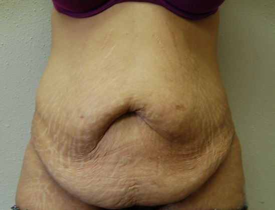 Massive Weight Loss : Case 15 - Before