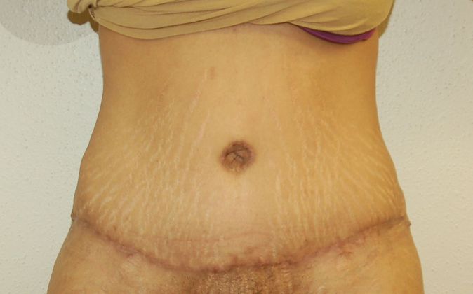 Massive Weight Loss : Case 15 - After