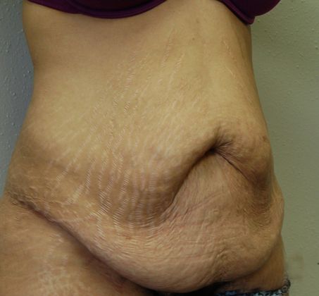 Massive Weight Loss : Case 15 - Before