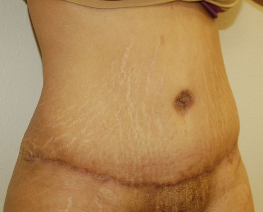 Massive Weight Loss : Case 15 - After