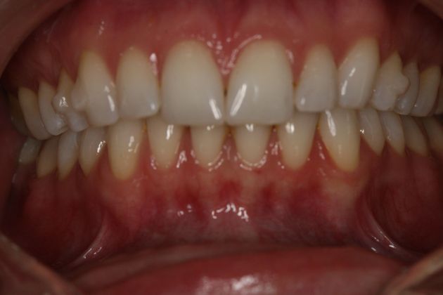 Porcelain Veneers Instant orthodontic/veneer case - Before