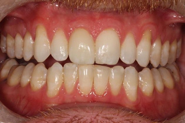 Crowns Photos, RESTORING A SINGLE FRONT TOOTH THAT HAD BEEN BONDED