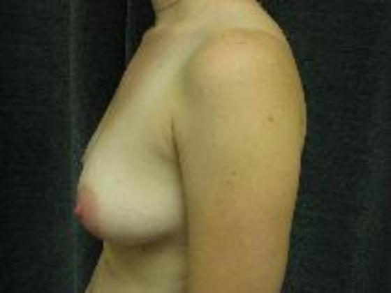 Breast Augmentation: Case 7 - San Antonio - Before Side
