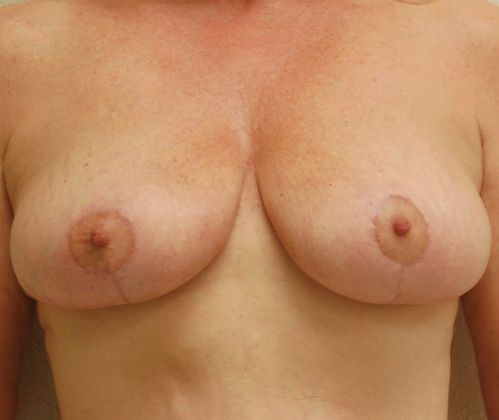Breast Lift (Mastopexy) Case 14 - After