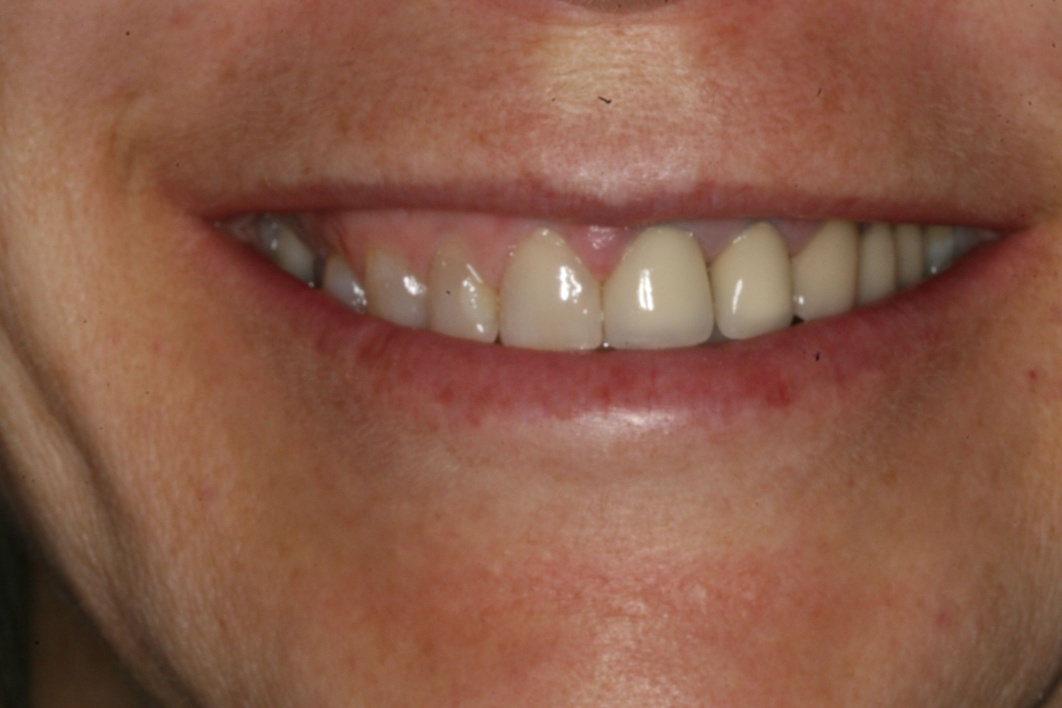 Full Mouth Rehabilitation using Veneers, Crowns and Implants Full