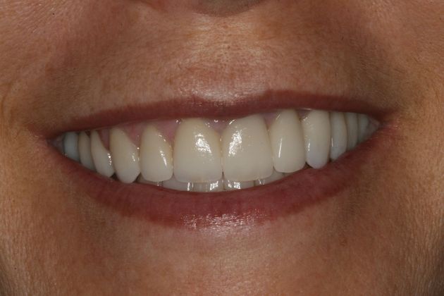Full Mouth Rehabilitation Full Mouth Rehabilitation using Veneers, Crowns and Implants - After