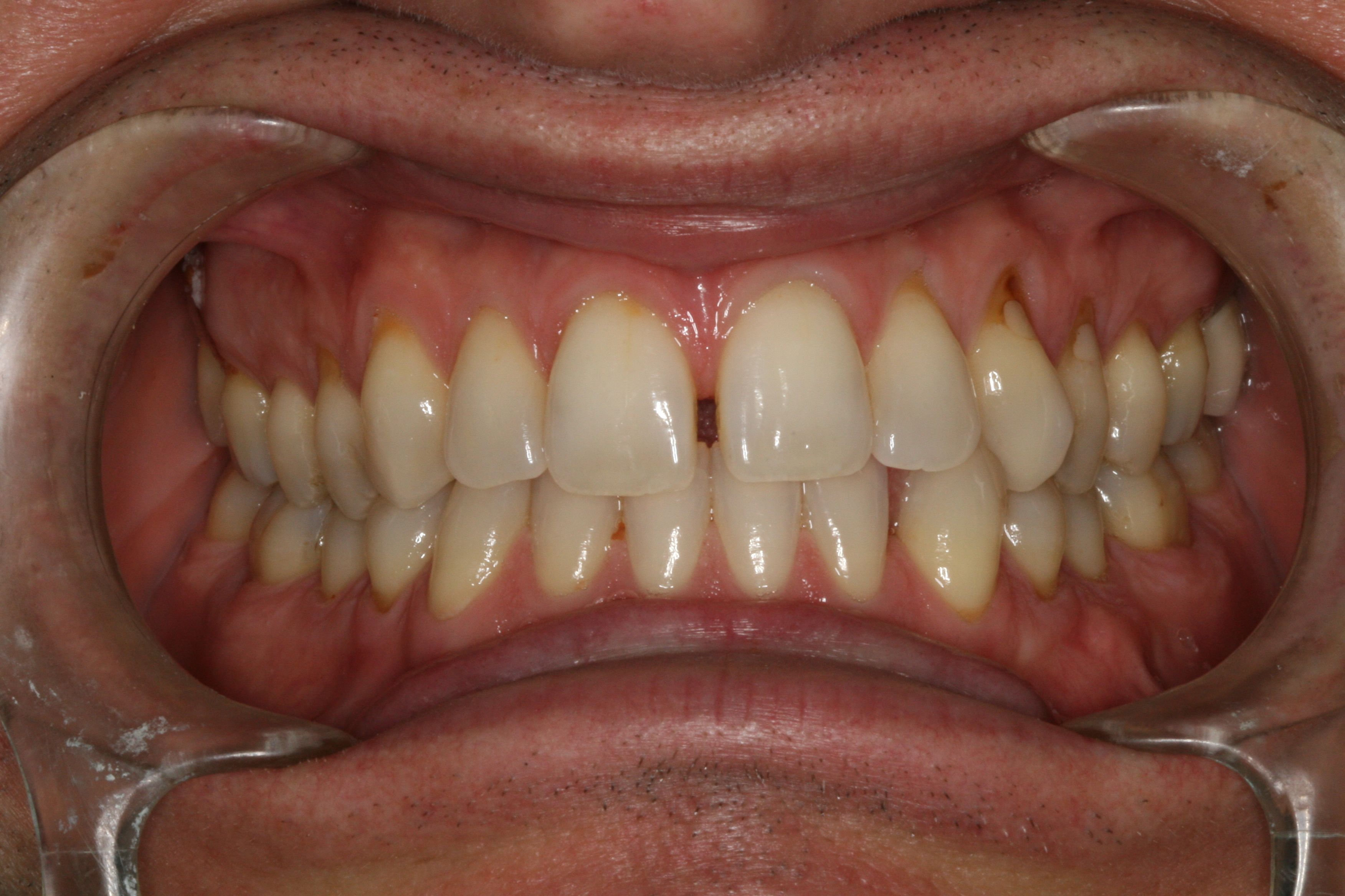 Space Closure/Pocelain Veneers - Porcelain Veneers - Before and After ...