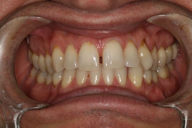 Porcelain Veneers Space Closure/Pocelain Veneers - Before