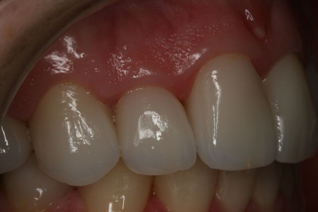 Porcelain Veneers: Porcelain Veneers/Smile Makeover - After Right Side