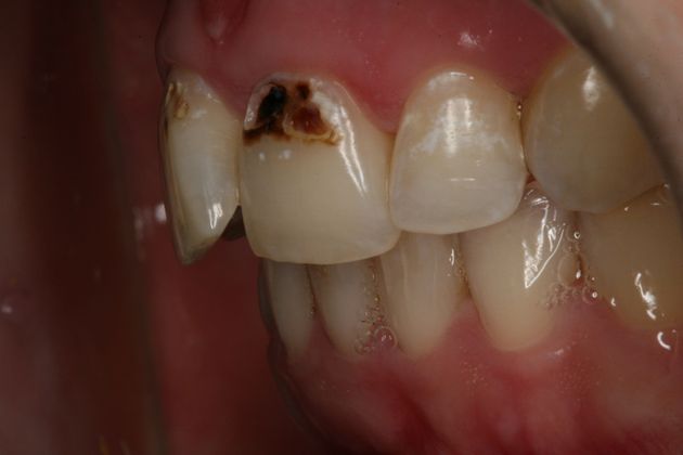 Porcelain Veneers: Porcelain Veneers/Smile Makeover - Before Left Side