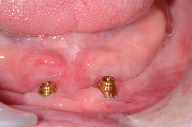 Dental Implants Case 2 - Edmonton - After