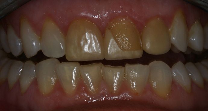 Veneers Anna - Before