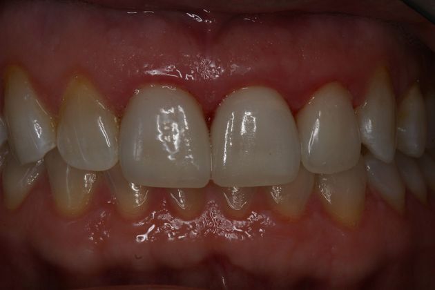 Veneers Anna - After