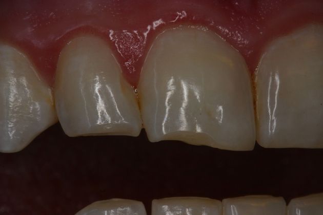 Cosmetic Bonding: Case 5 - Before